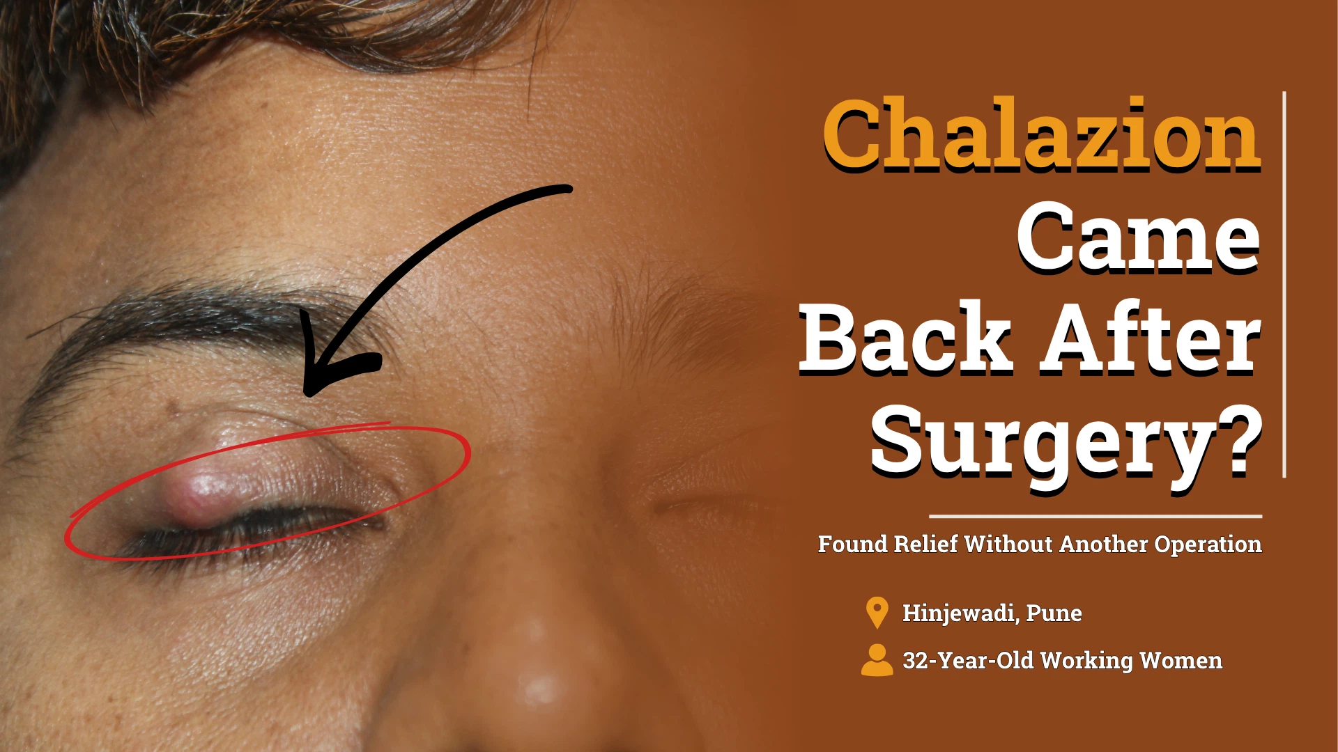 Chalazion Came Back After Surgery 52911