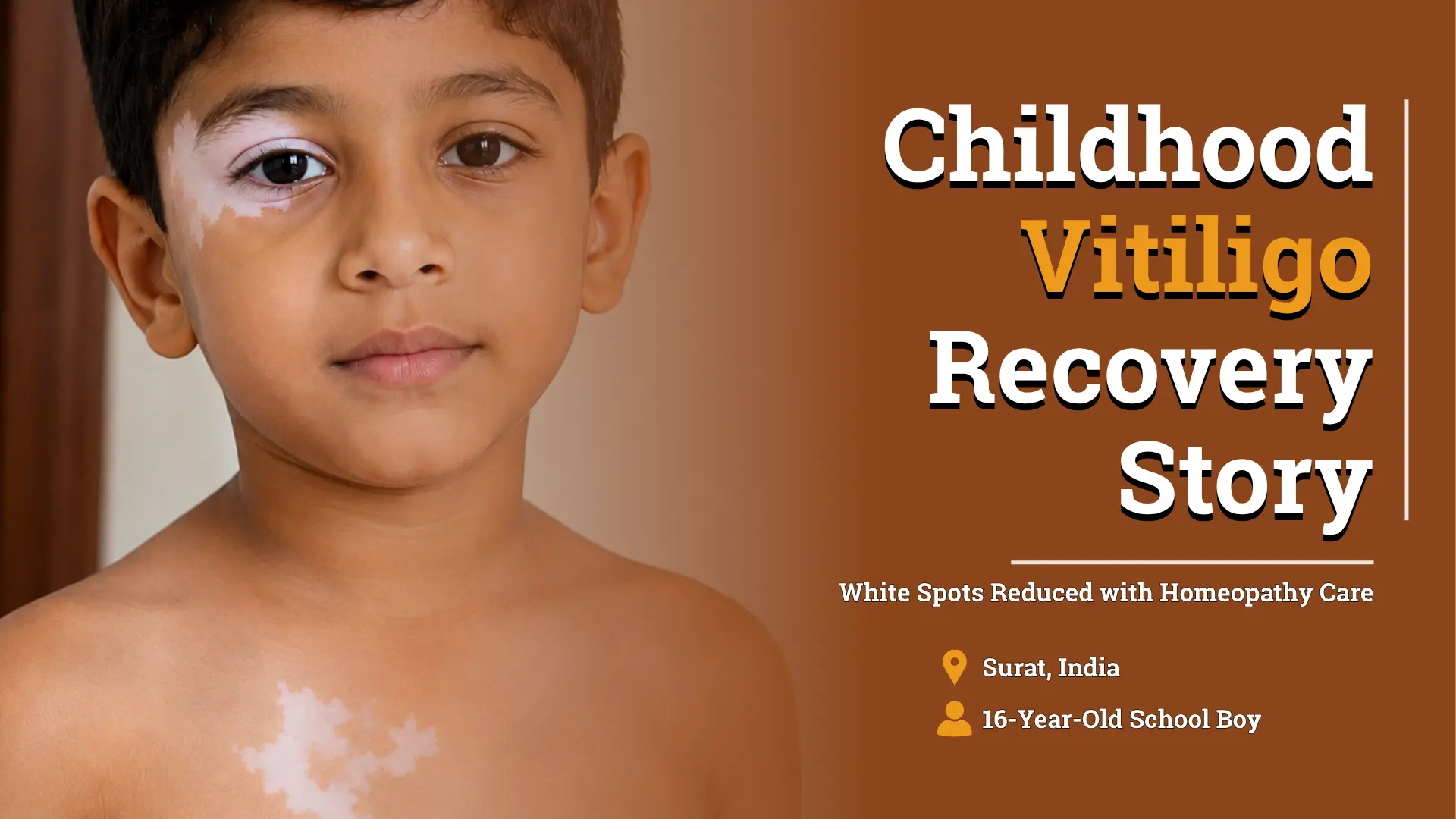 Vitiligo Affected Kid Recovered In 8 Months With LifeForce Homeopathy Treatment - Life Force Homeopathy