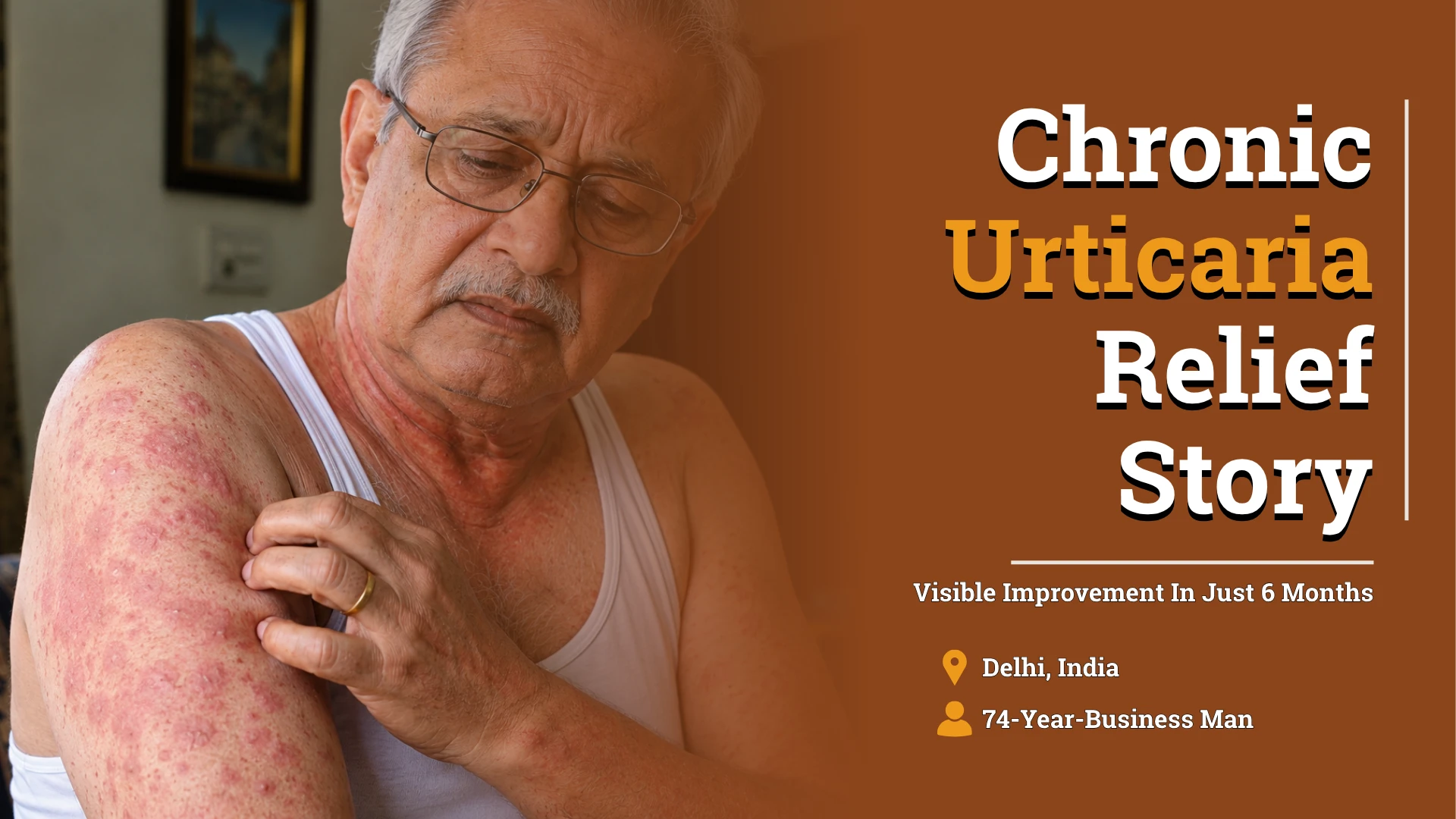 A 74-Year-Old Found Remarkable Relief from 10 Years Chronic Urticaria in Just 6 Months with Homeopathy
