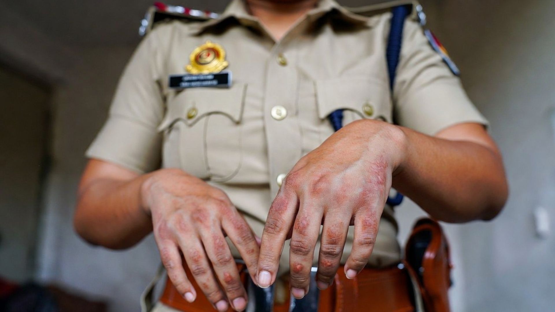 Policewoman with Chronic Relapsing Urticaria