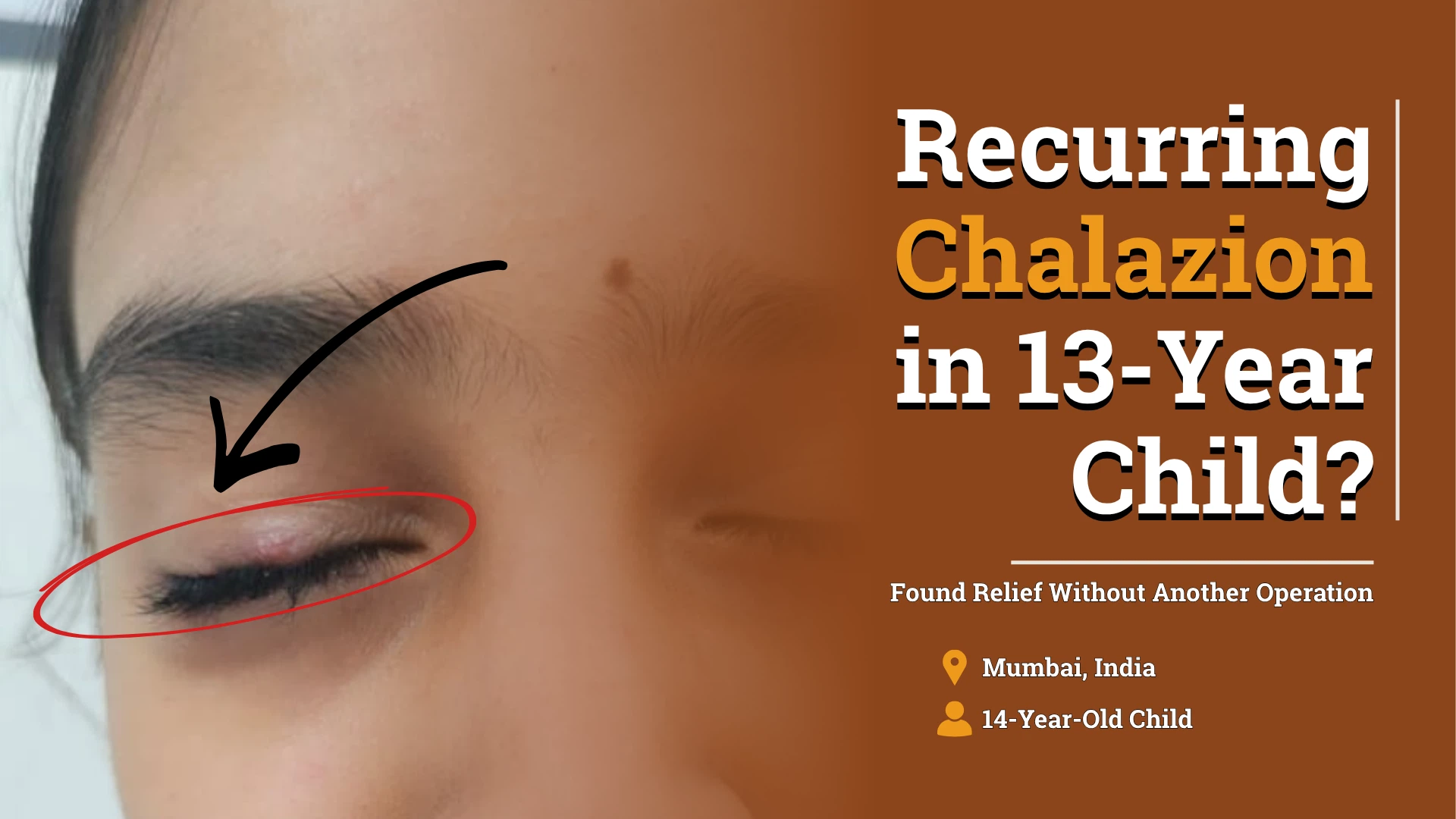 Recurring Chalazion in 13-Year Child 55962 v2