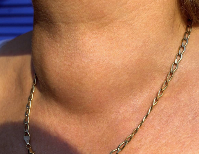 goiter