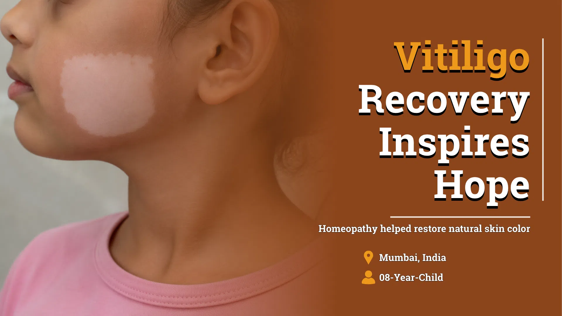 A small girl developed vitiligo after emotional trauma and was cured with homeopathy
