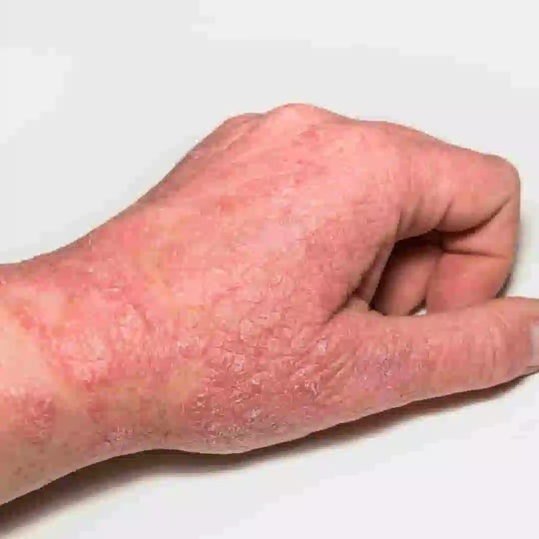 Eczema homeopathic skin treatment
