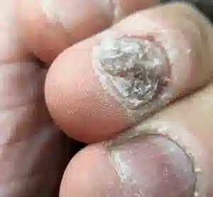 Homeopathy for fungal skin infections