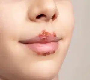 Herpes homeopathic skin treatment