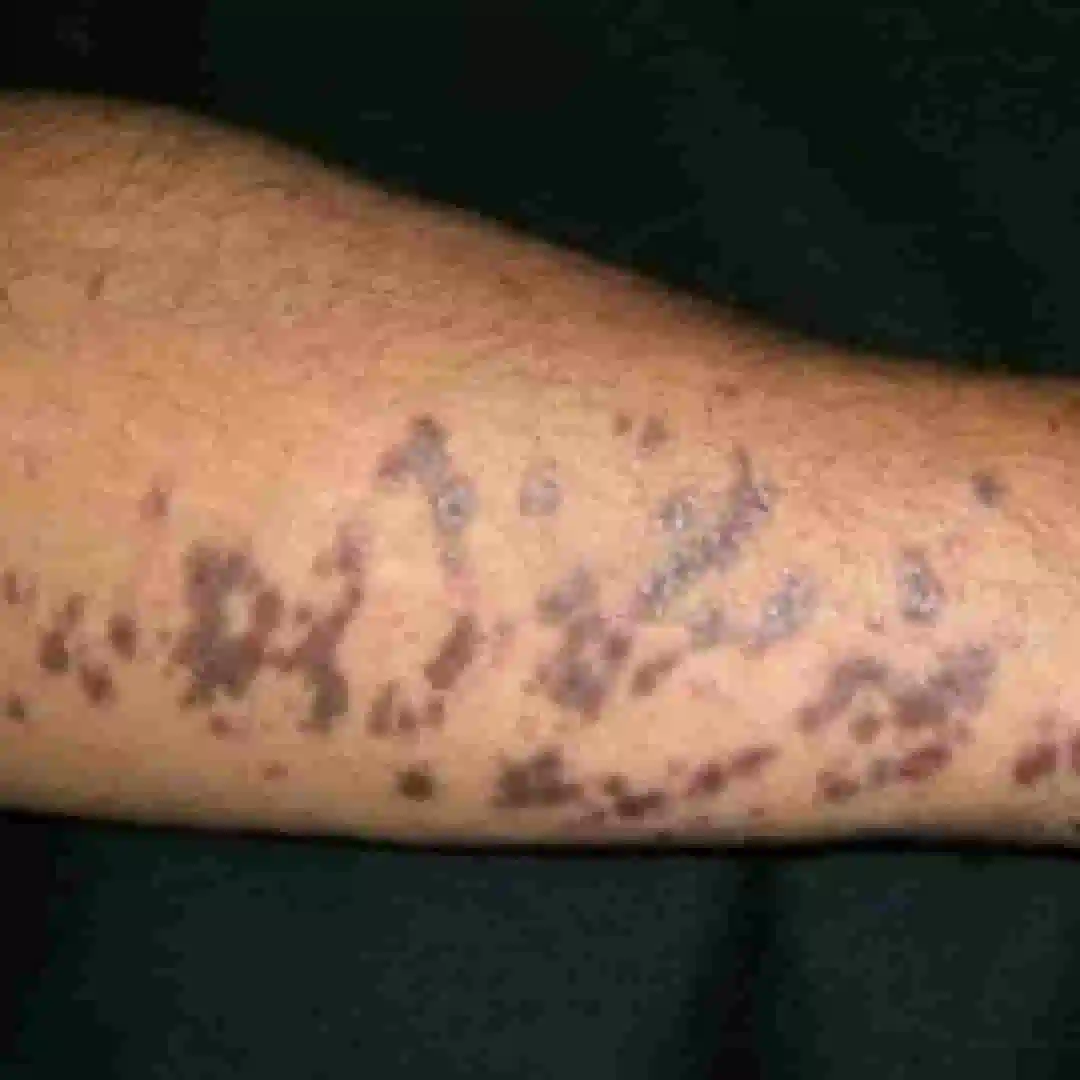 Close-up of lichen planus on skin