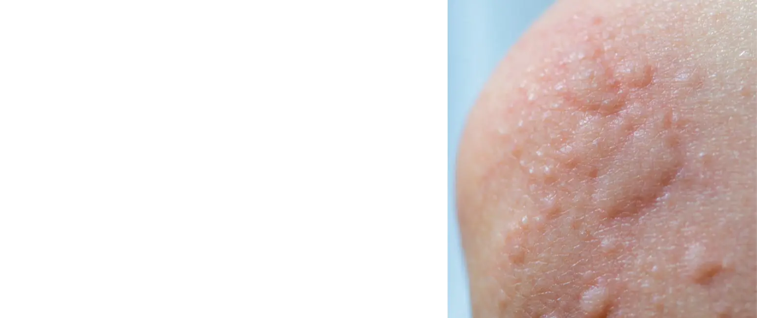 Urticaria red itchy skin rash