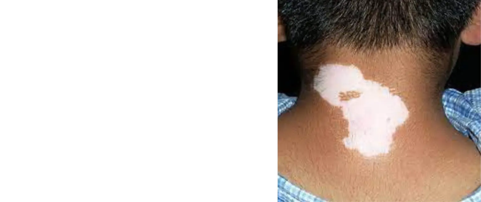Vitiligo white skin depigmentation