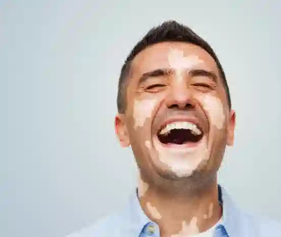 Vitiligo white patches on skin