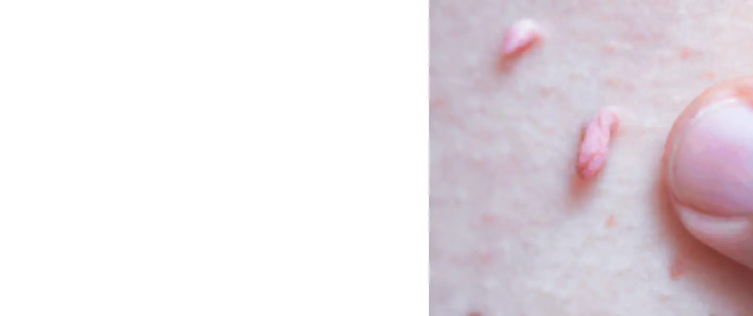 Warts raised skin growth closeup