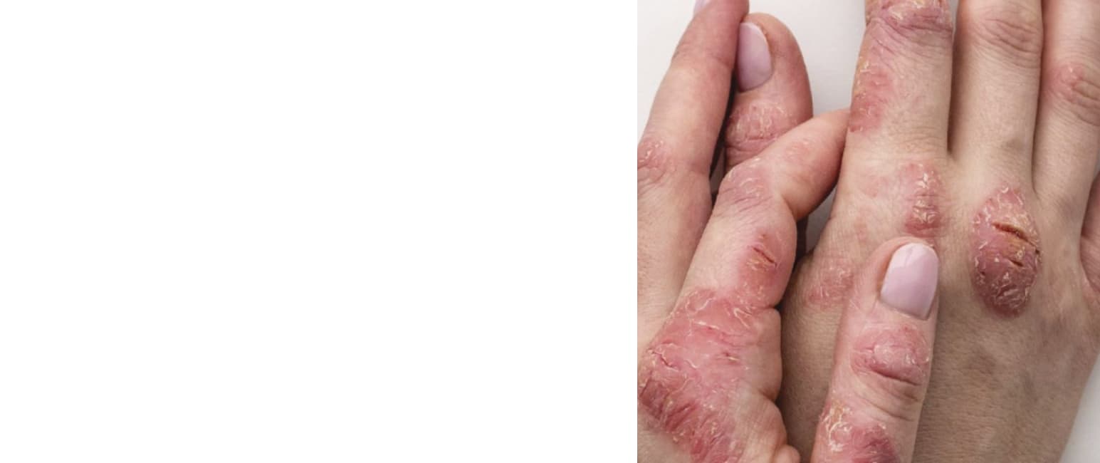 Eczema inflamed dry skin patches