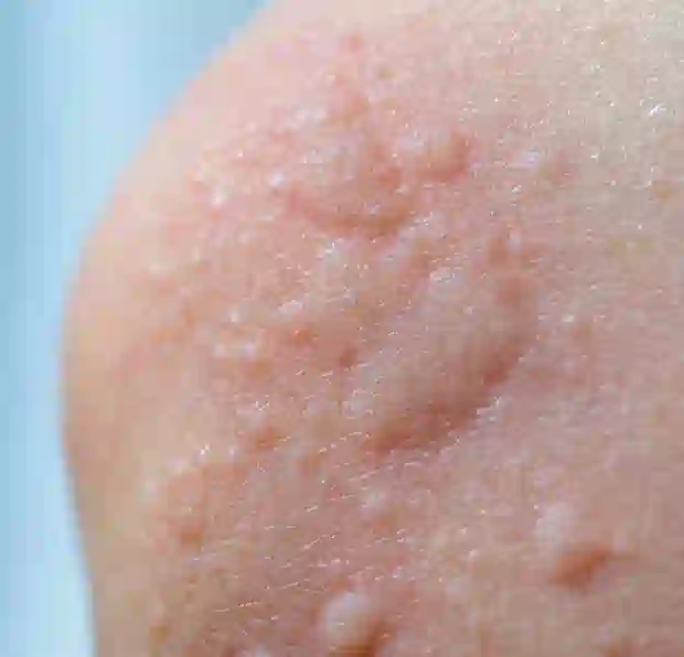 Urticaria hives red itchy welts.