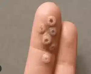 Viral warts rough cauliflower-like growths on skin.