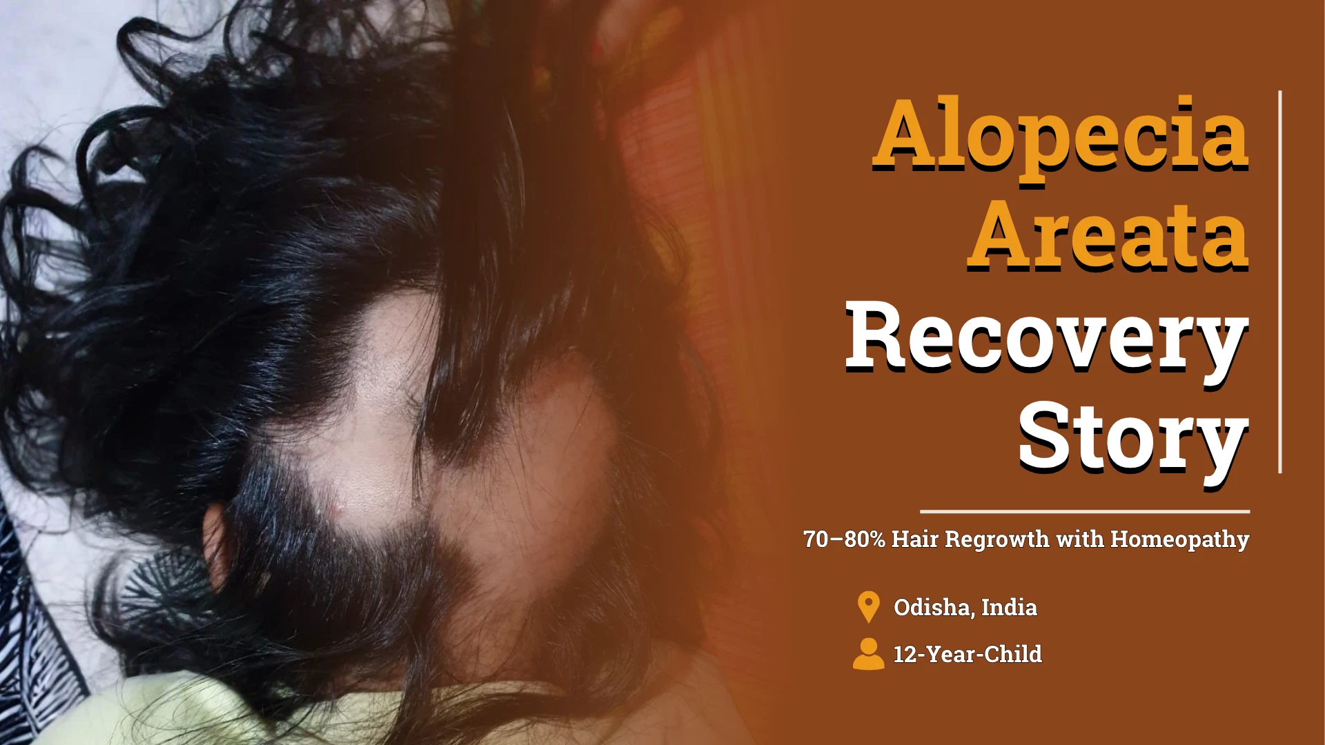 Childhood Alopecia Areata Case Study: Hair Regrowth with Homeopathic Treatment Over 4 Years
