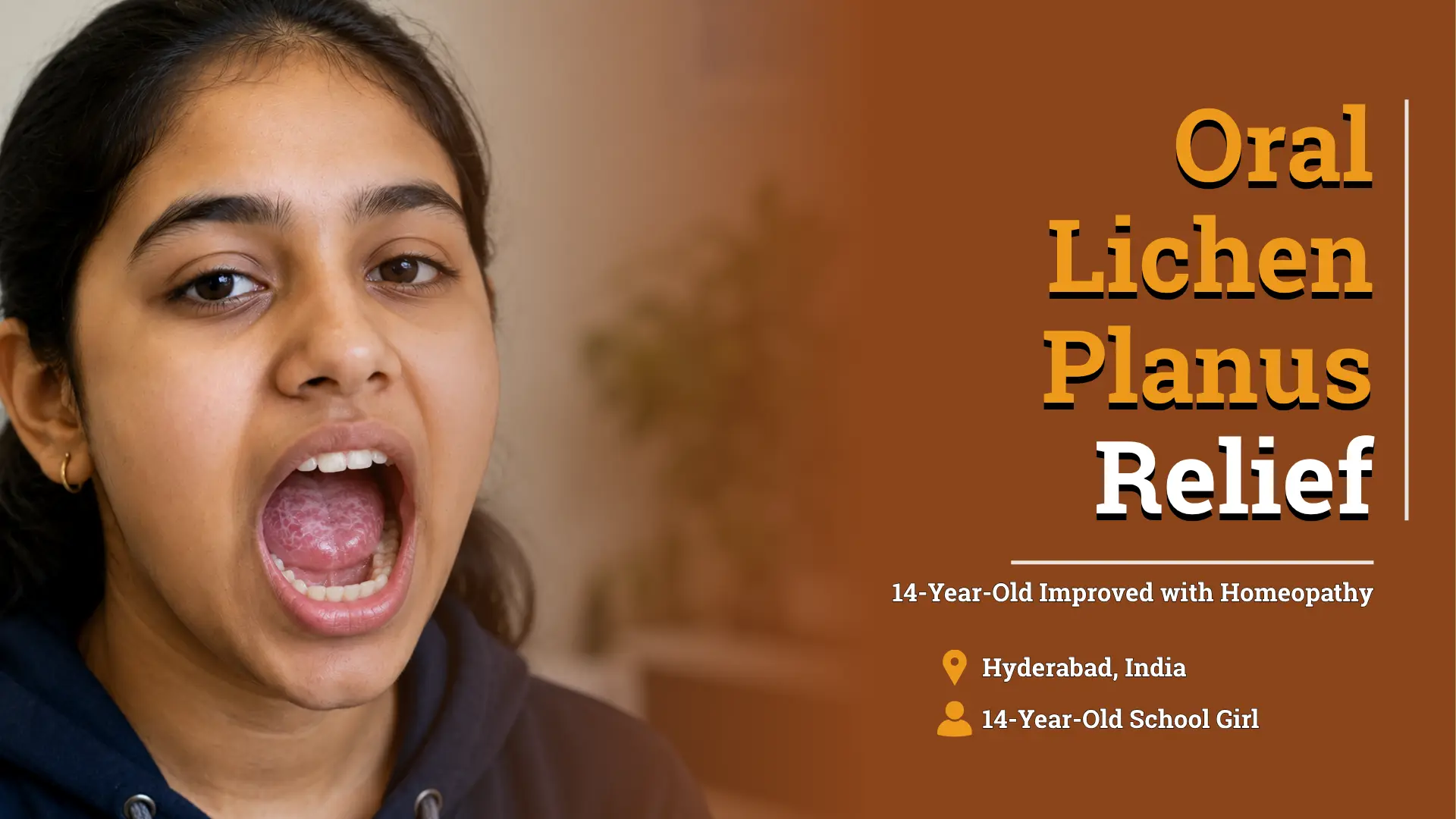 14-Year-Old Girl Achieves Progressive Remission from Oral Lichen Planus with Homeopathic Treatment