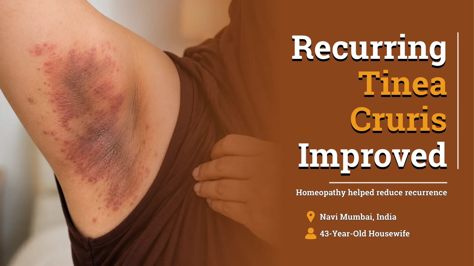 Relief in Chronic Recurrent Fungal Infection with Homeopathy