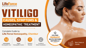 Vitiligo causes symptoms and homeopathic treatment guide by Life Force Homeopathy Chembur