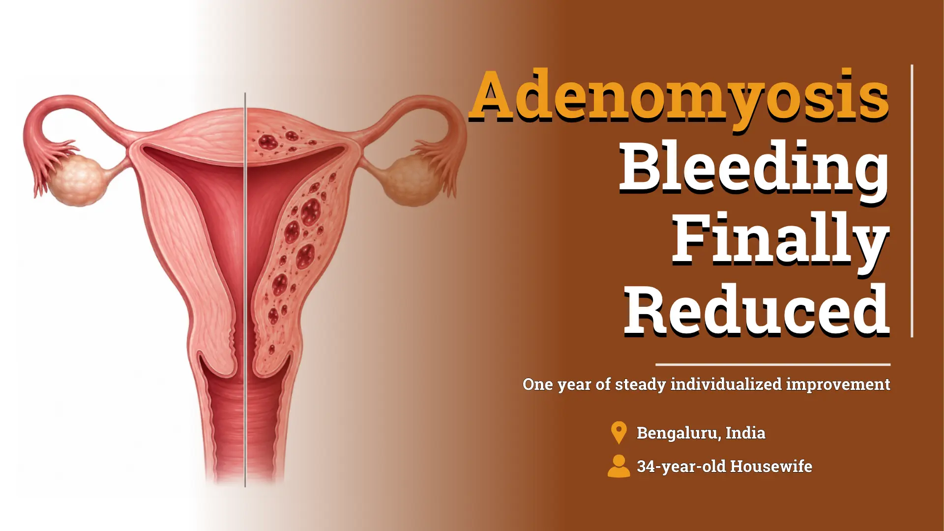 Adenomyosis Symptoms Improved With Individualized Homeopathic Treatment
