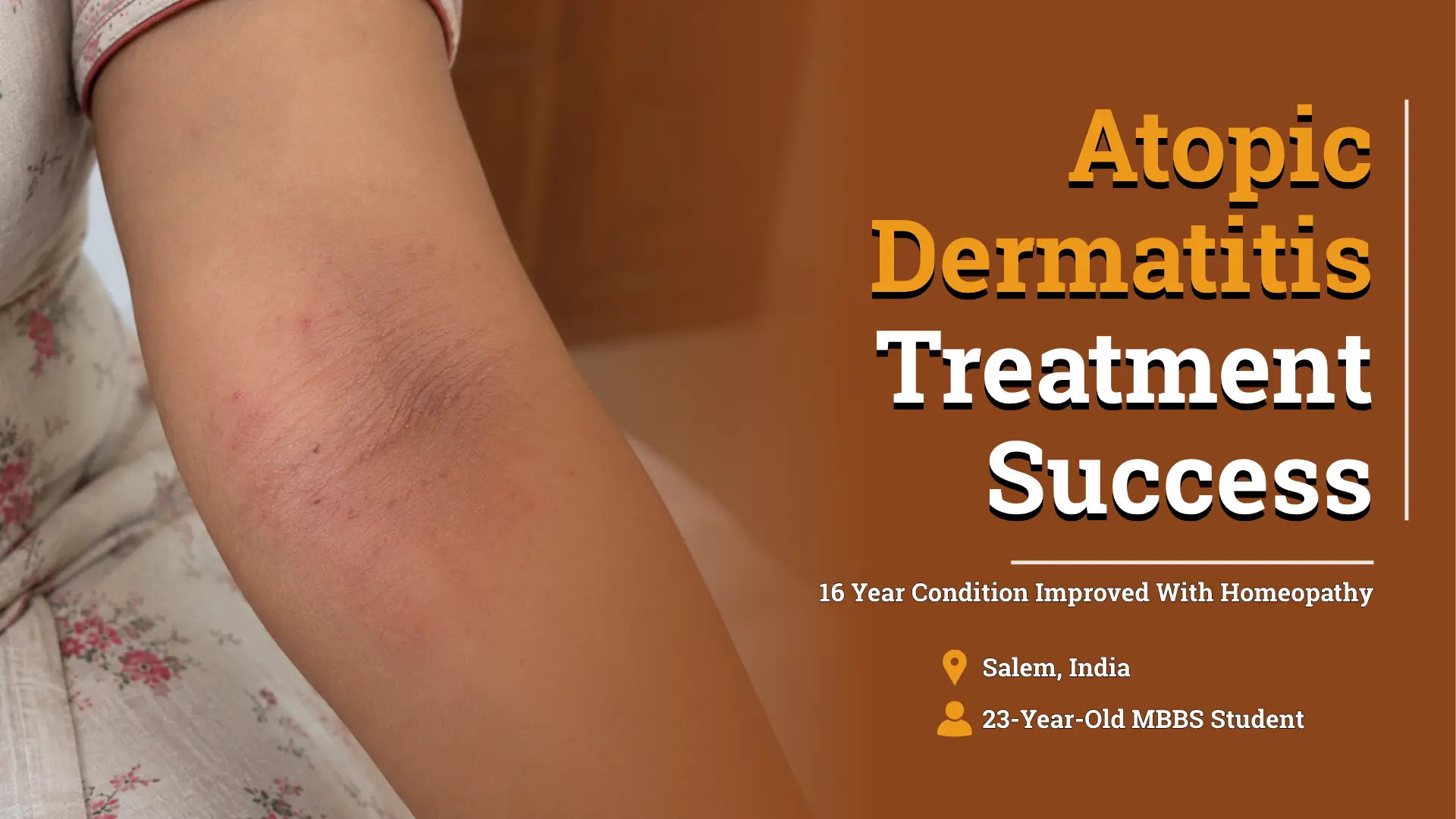 16 Years of Atopic Dermatitis Improved With Homeopathy at Life Force Jayanagar