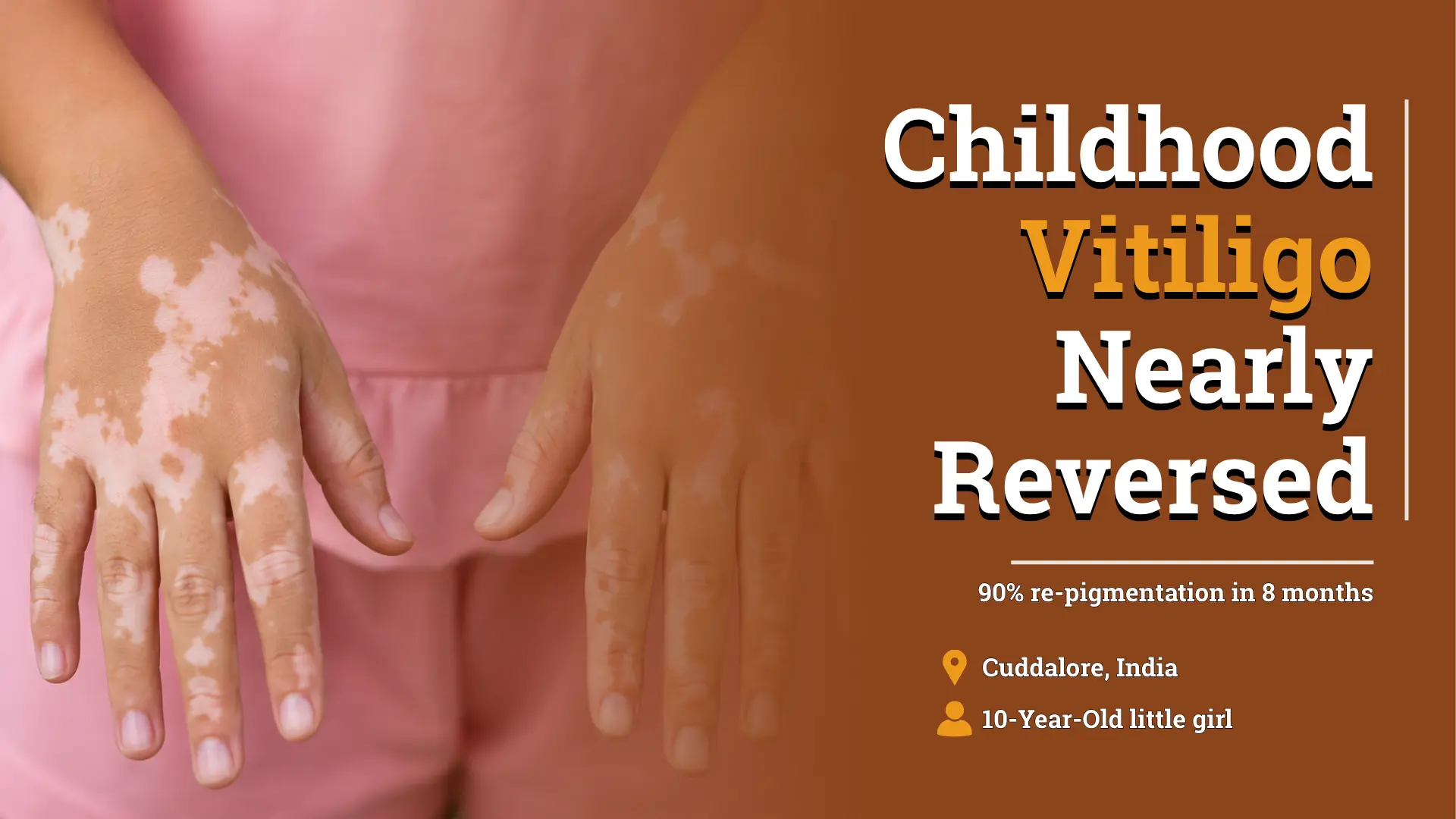 Facial Vitiligo in a Child Improved With Individualized Homeopathic Treatment