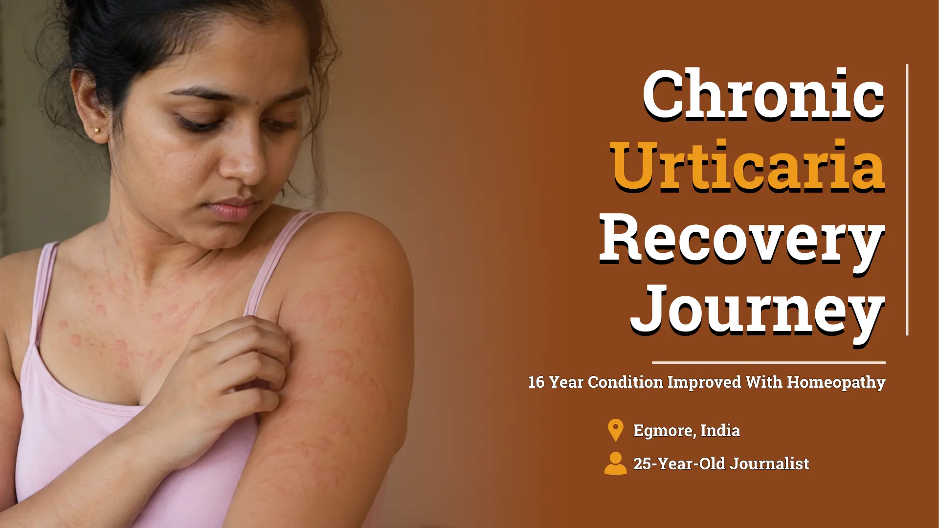 Chronic Urticaria Improved With Individualized Homeopathic Treatment