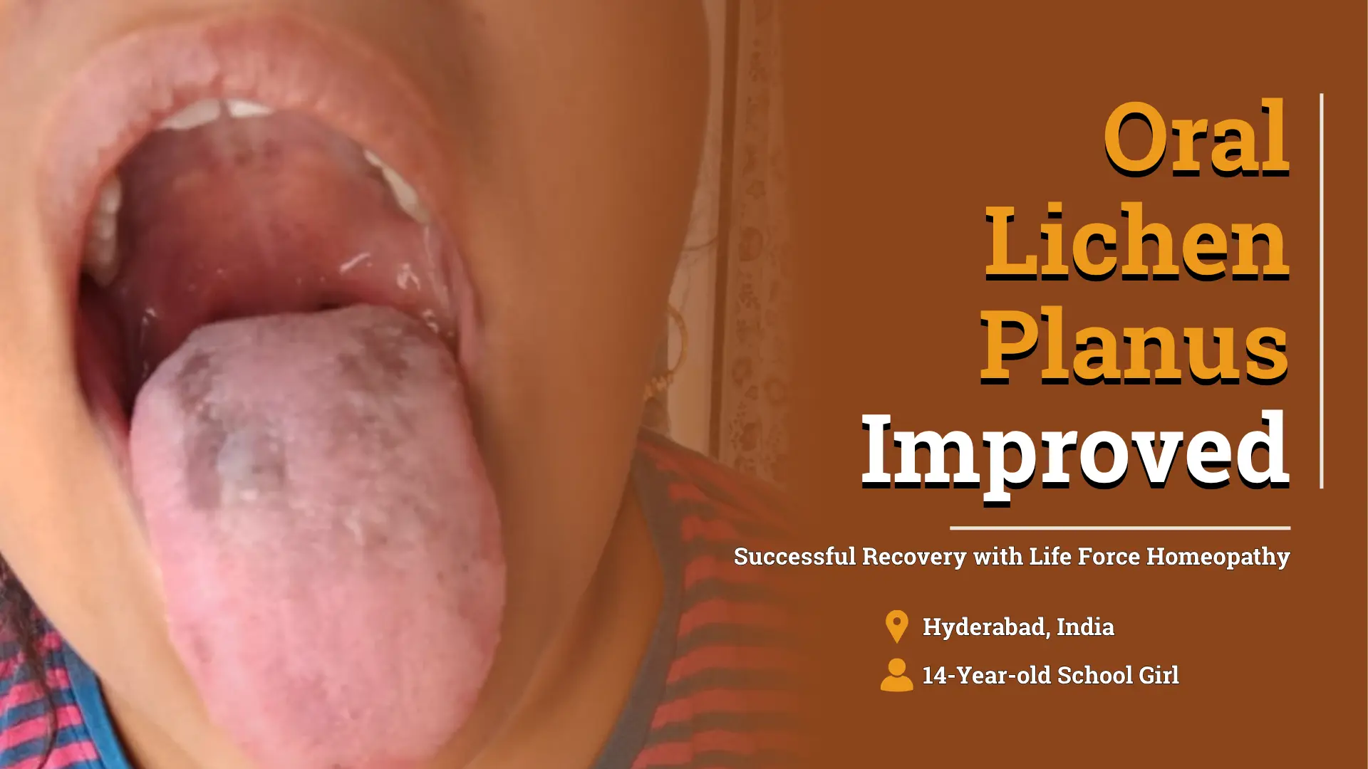 Oral Lichen Planus Improved With Individualized Homeopathic Treatment