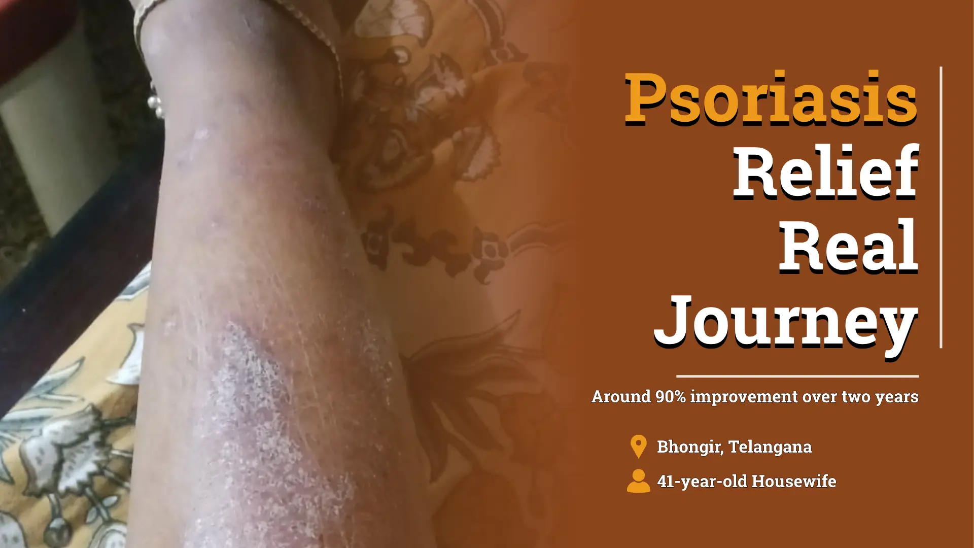 Chronic Psoriasis Improved With Individualized Homeopathic Treatment