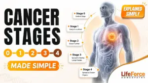 Cancer stages from Stage 0 to Stage 4 explained with a medical illustration and timeline by Life Force Homeopathy
