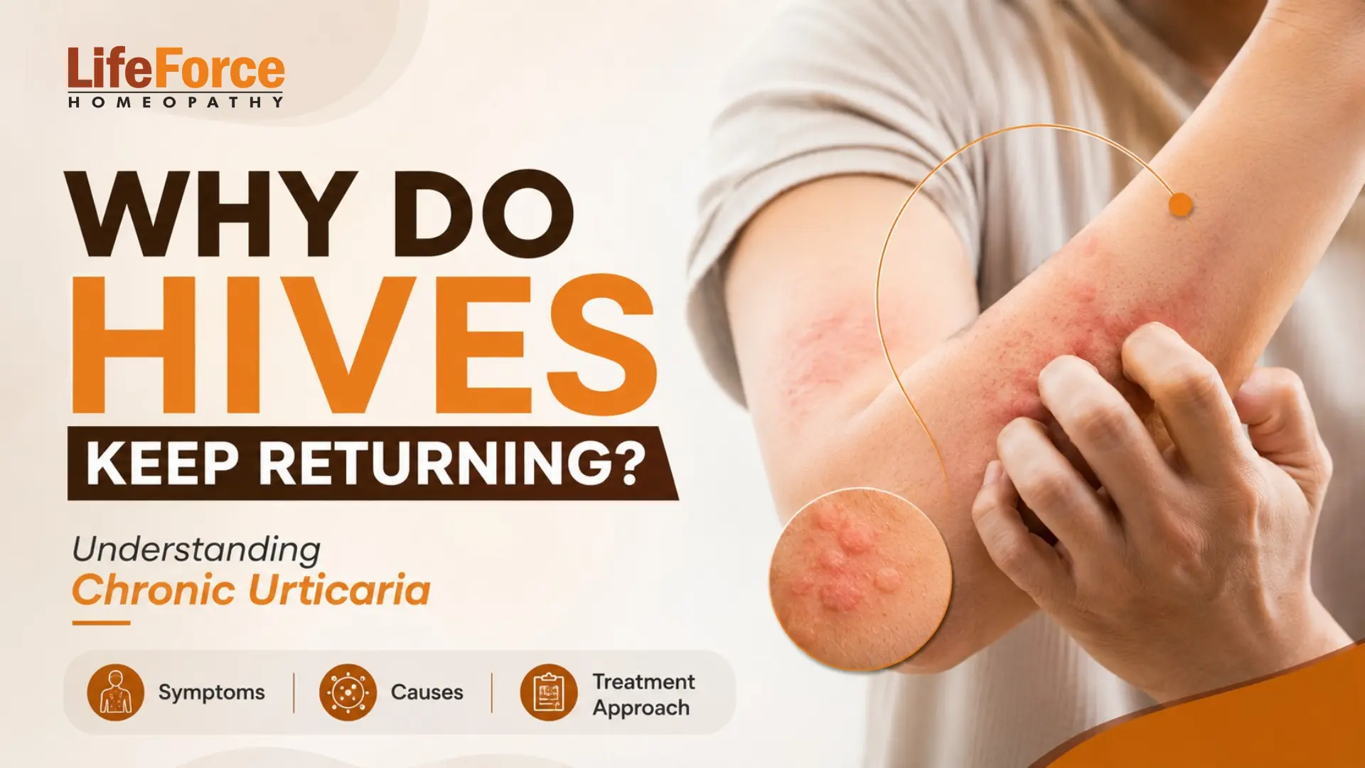 Chronic Urticaria: Symptoms, Causes, Triggers, and Treatment Approach