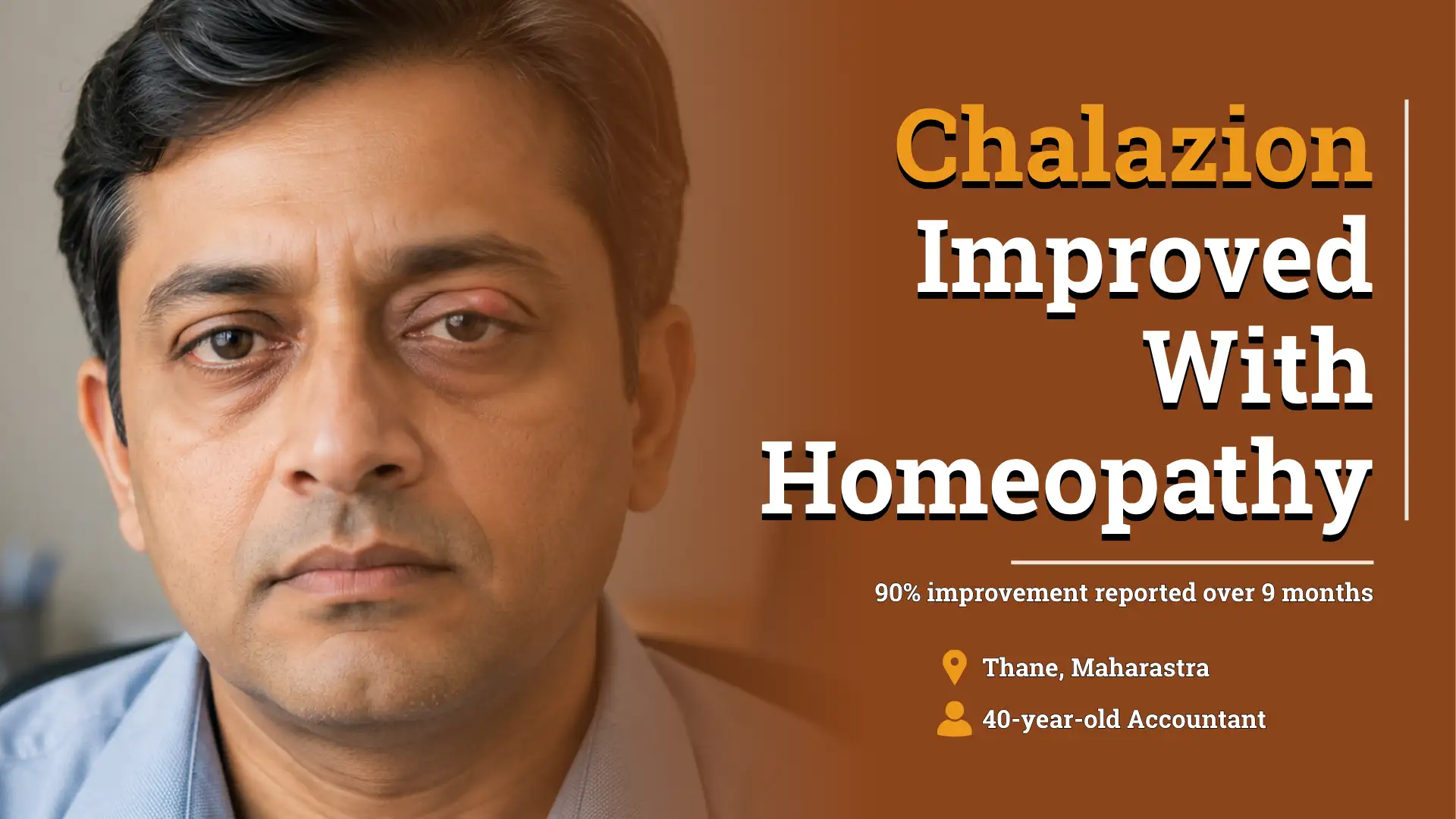 Recurrent Chalazion in Both Eyes Improved With Homeopathic Treatment