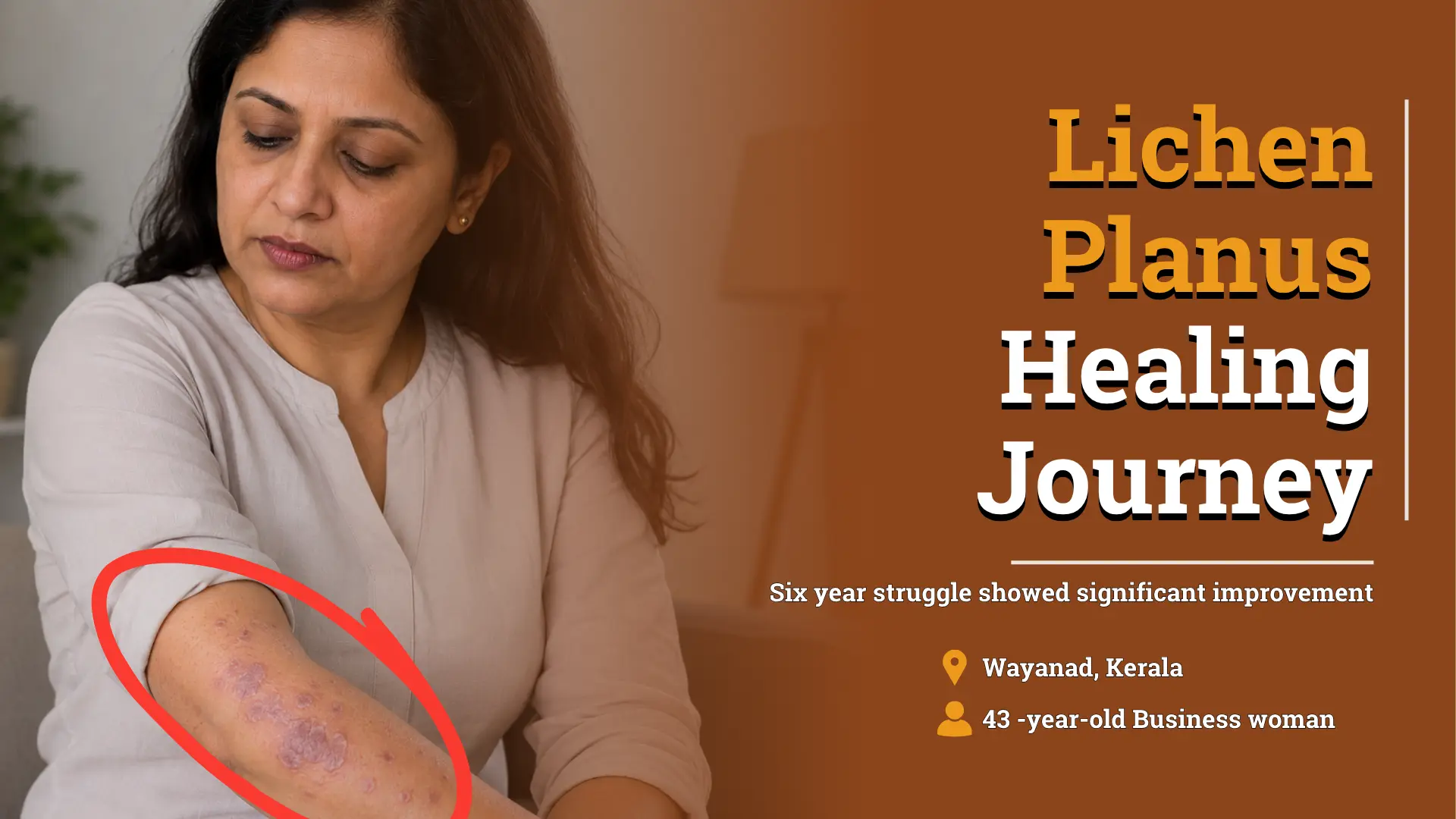 Thumbnail showing a 43-year-old Indian businesswoman looking at lichen planus lesions on her forearm, highlighting her healing journey after individualized homeopathic treatment.