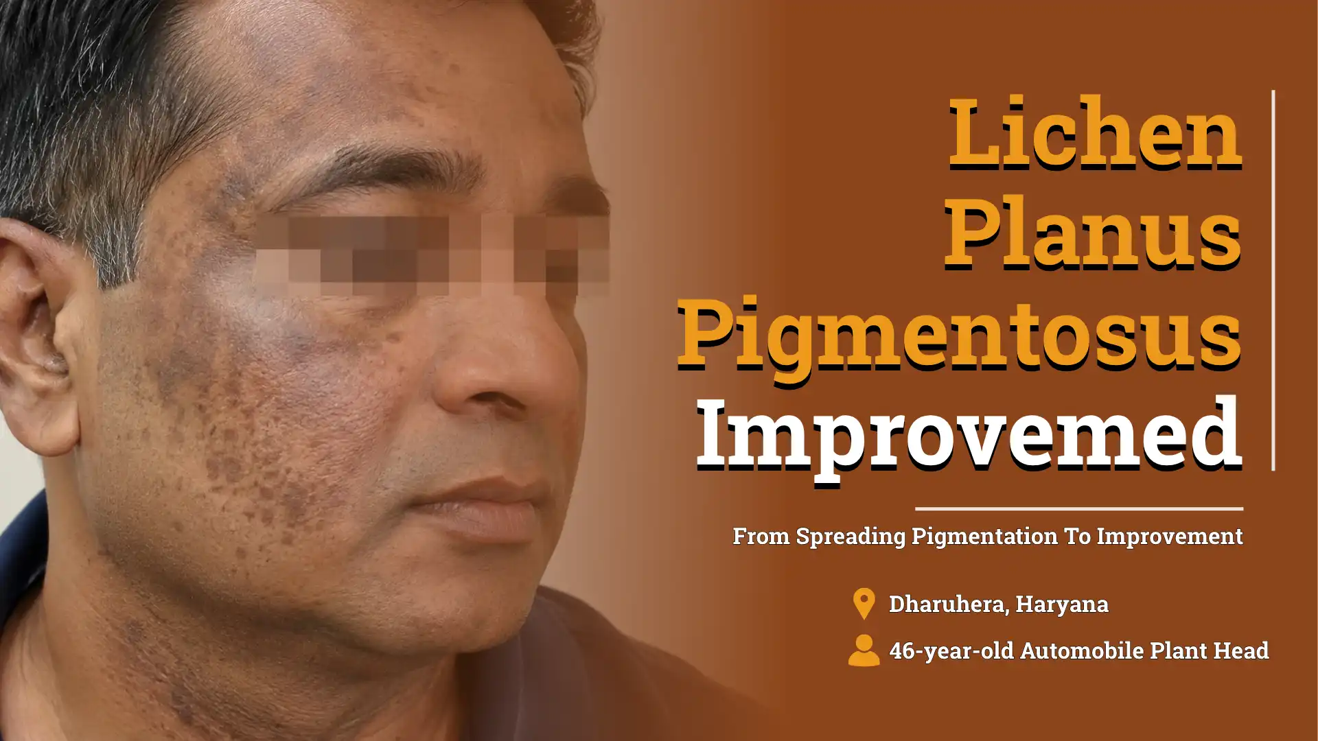 Lichen Planus Pigmentosus facial pigmentation case study thumbnail showing a 46-year-old man with dark patches on the cheeks and face