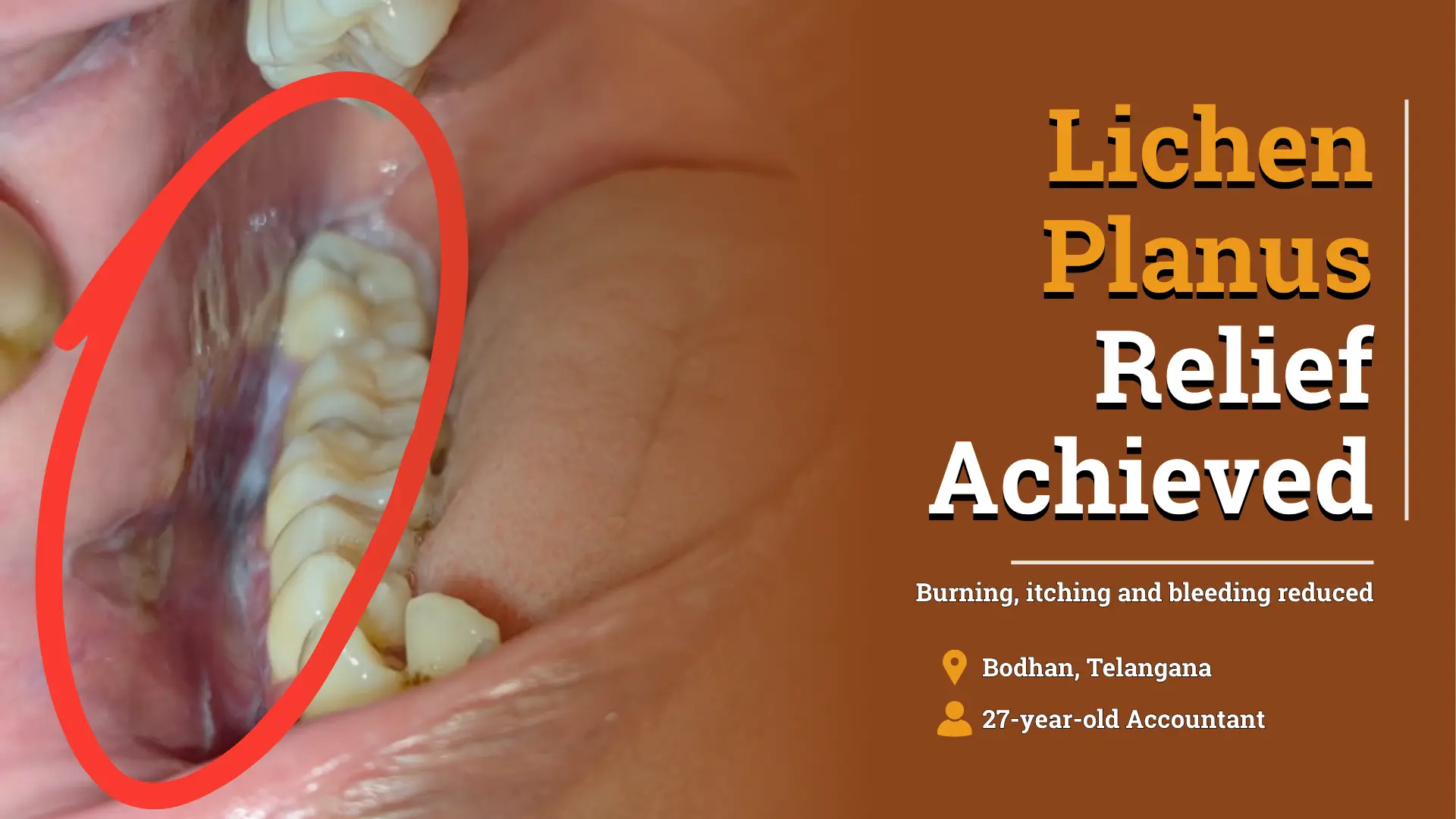 Oral, Cutaneous, and Genital Lichen Planus Improved With Homeopathy