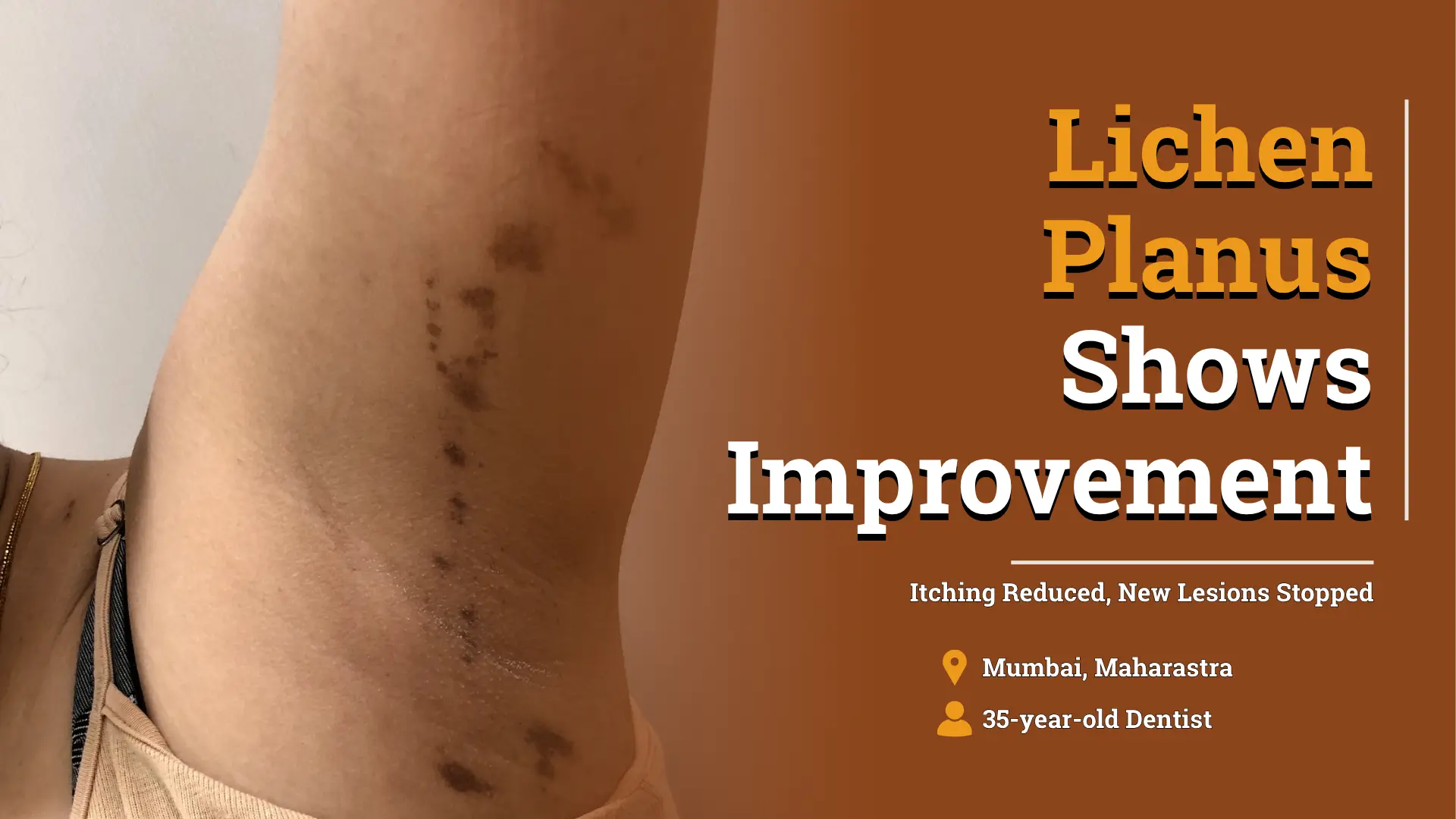 Lichen Planus case study thumbnail showing skin lesions with improvement in itching and no new lesions in a 35-year-old female dentist