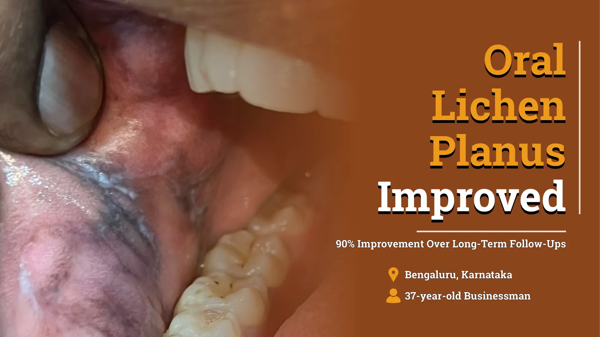 Oral lichen planus case study showing oral lesions in a 37-year-old businessman with 90% improvement