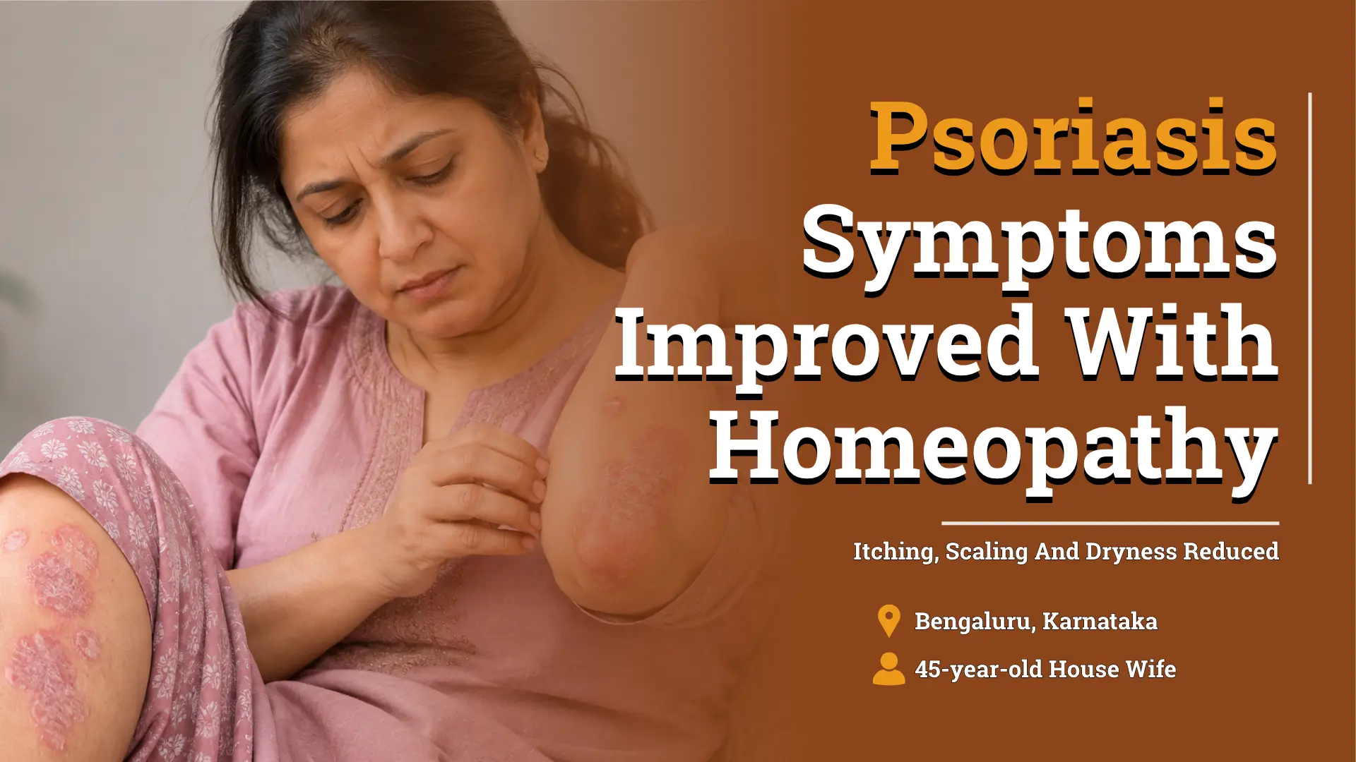 45-Year-Old Woman’s Chronic Psoriasis Improved by 90% With Homeopathy