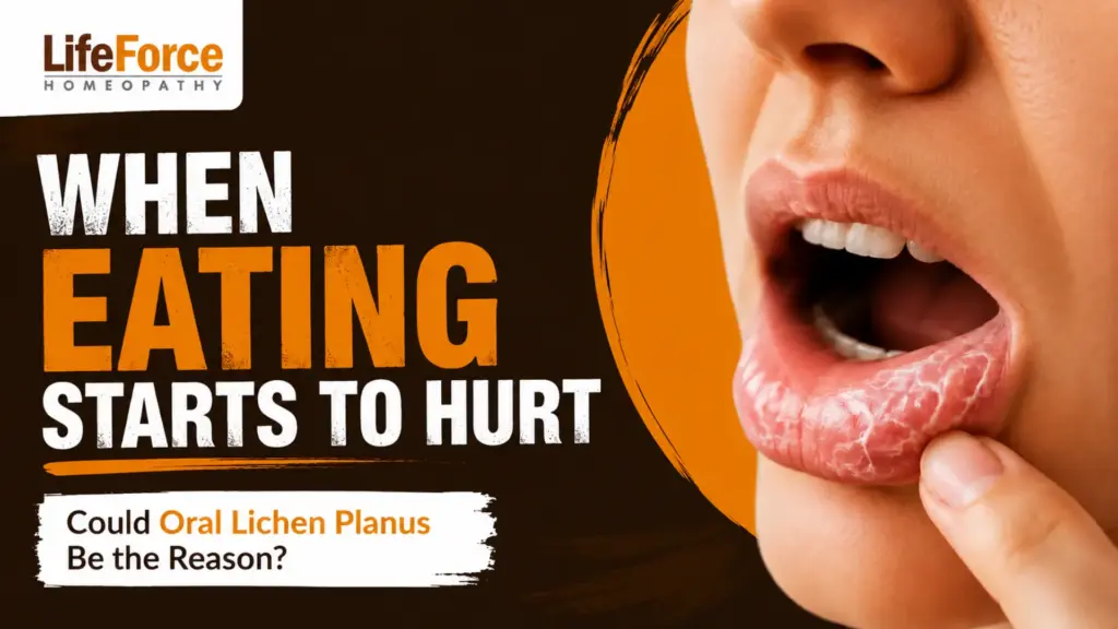 Oral lichen planus causing painful eating and mouth discomfort