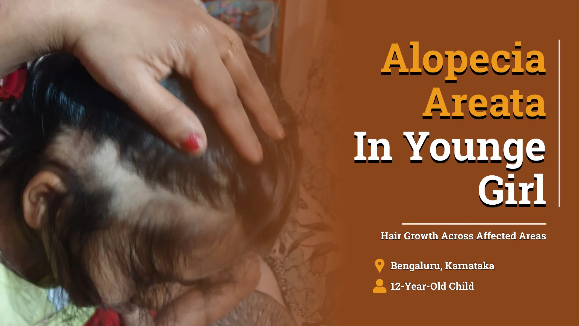 When Hair Loss Started Affecting a Child’s Confidence: A Four-Year Journey With Alopecia Areata