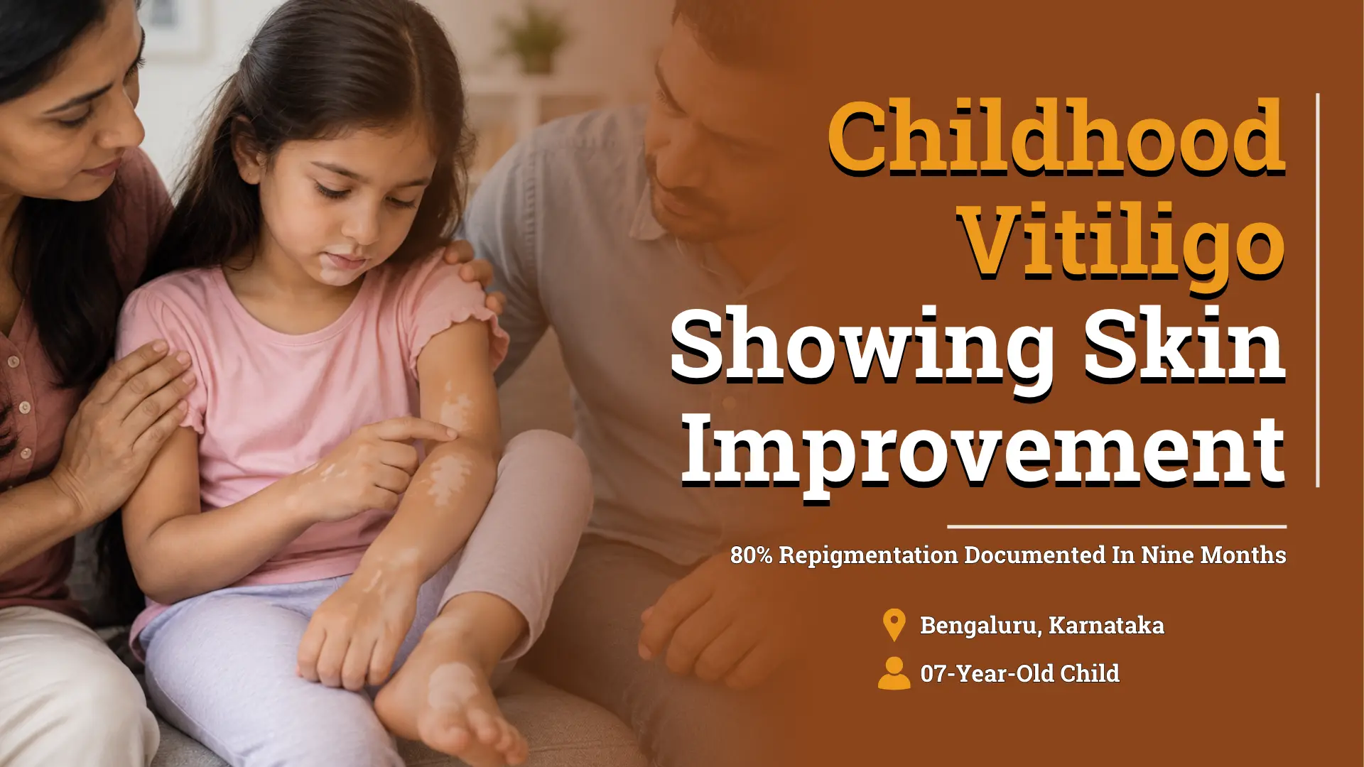Childhood Vitiligo: A 7-Year-Old Girl’s Journey Towards 80% Repigmentation