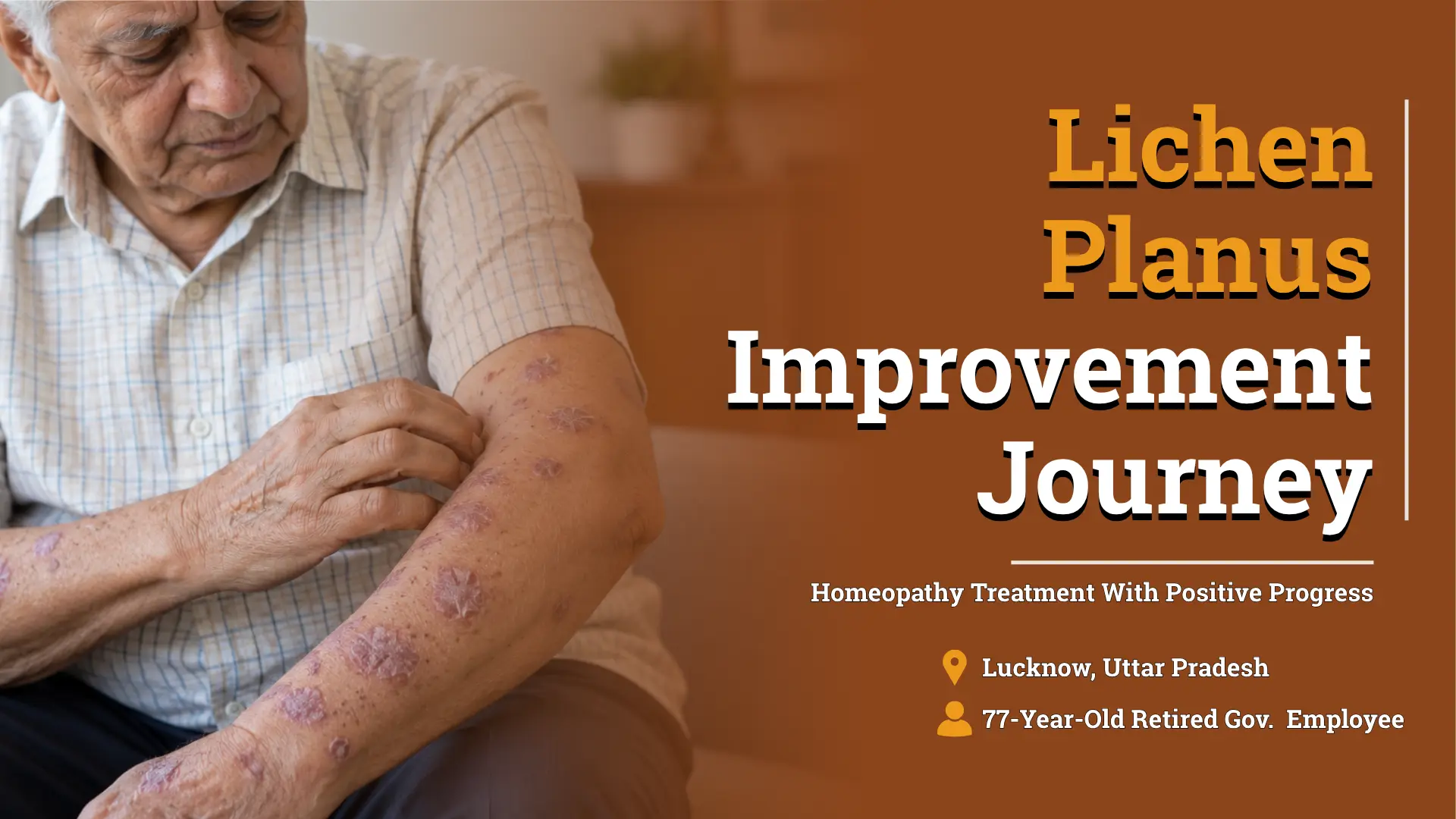 Five Months of Itching and Recurring Skin Lesions: An 80% Improvement Journey With Lichen Planus